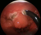 bacchetta del diametro PLA402 Tonsilectomy di 4.4mm per ambulatorio medico