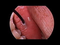 Generatore al plasma a radiofrequenza per il trattamento del russamento con sonda multifunzione