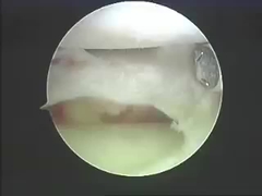 Prodotti di ablazione dei sistemi di ablazione degli strumenti di Electrosurgical per la spina dorsale ed i giunti