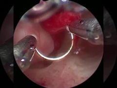 Tecnologia fresca Elettrodo plasmatico chirurgica per procedure di urologia BPH