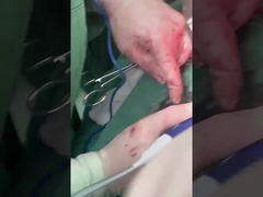 Proba di epatologia clinica PLA408 per chirurgia aperta